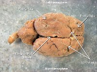 11 Longitudinal fissue-central sulcus-frontal-parietal lobe-01 : longitudinal fissure, central sulcus, frontal lobe, parietal lobe