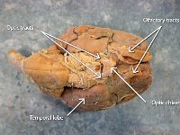 13 optics tracts-chasm-olfactory tracts-temporal lobe : optics tracts, optic chiasm, olfactory tracts, temporal lobe