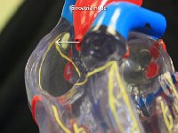 14 Sinoatrial node : sinoatrial node, heart, pacemaker, conduction system