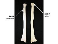 32 head of radius and radial tuberosity : head of radius, radial tuberosity, ulna, upper limb