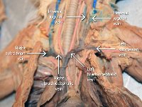 39 jugular-subclavian-brachiocephalic veins-01 : internal jugular vein, external jugular vein, right brachiocephalic vein, left brachiocephalic vein, left and right subclavian vein