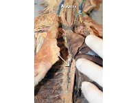 40 Azygous-01 : angle, posterior border, facial bone, skull